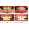 truewhite Advanced Plus Whitening System for two People